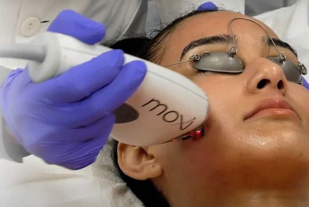 A Young lady getting laser treatment by Moxi Device | Torstveit Medical Aesthetics in Phoenix AZ