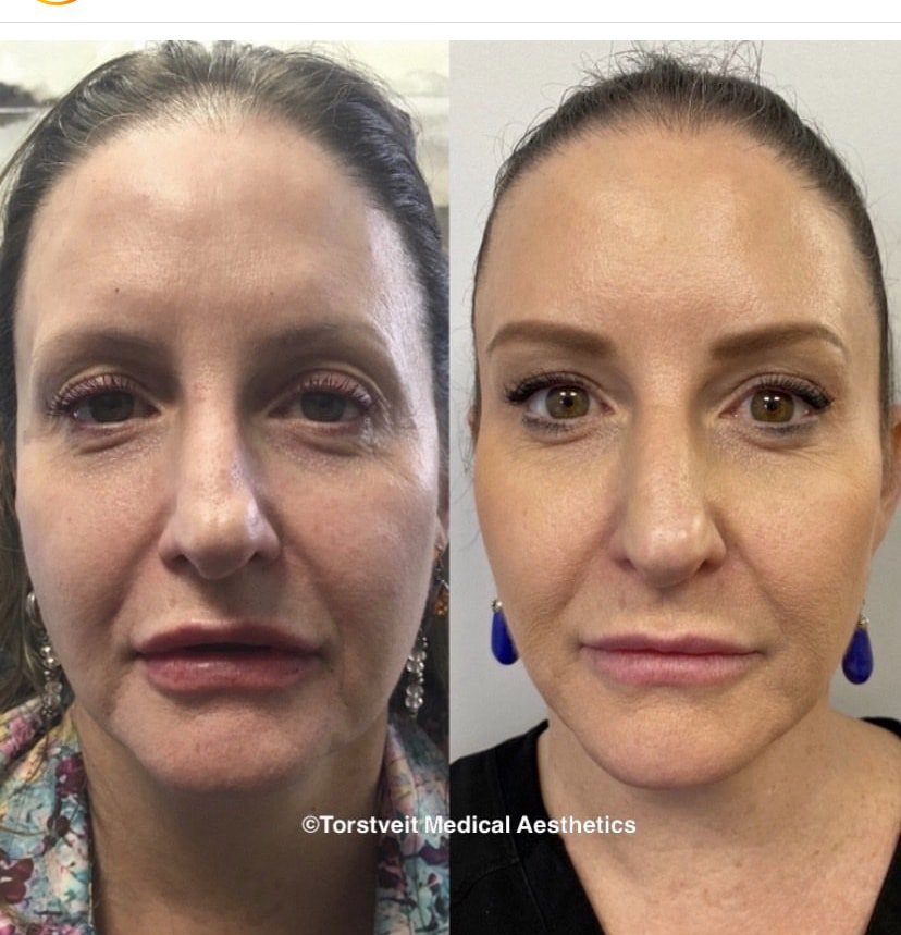 BBL Hero Moxi Treatment Before & After Photos | Torstveit Medical Aesthetics in Phoenix, AZ