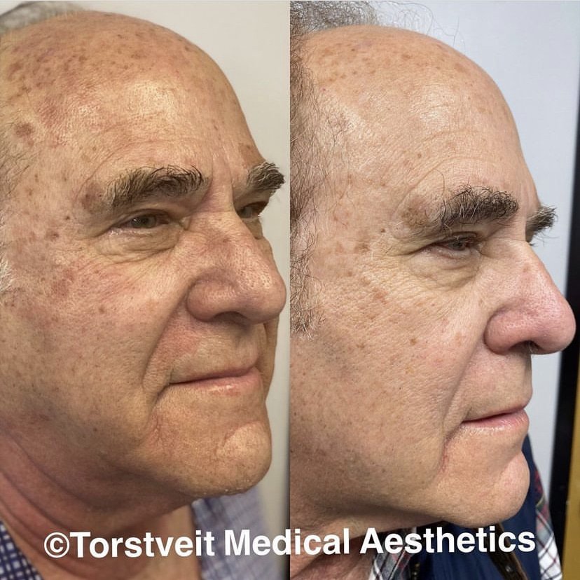 BBL Hero Moxi Treatment Before & After Photos | Torstveit Medical Aesthetics in Phoenix, AZ