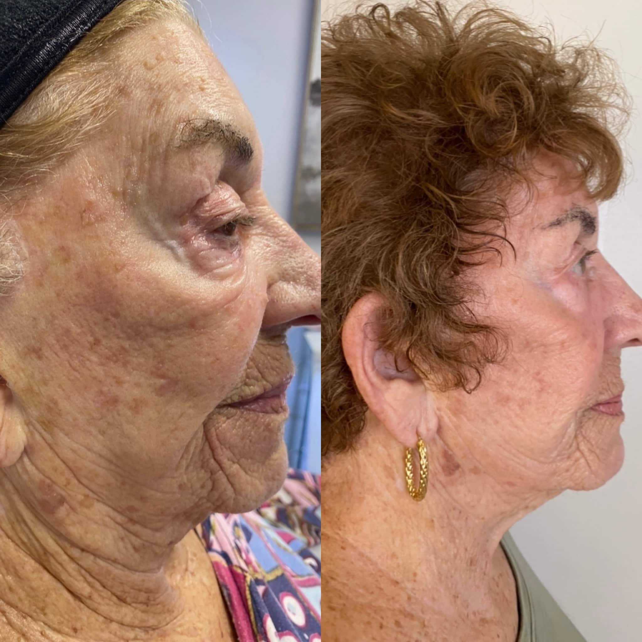 BBL Hero Moxi Chin Treatment Before & After Photos | Torstveit Medical Aesthetics in Phoenix, AZ