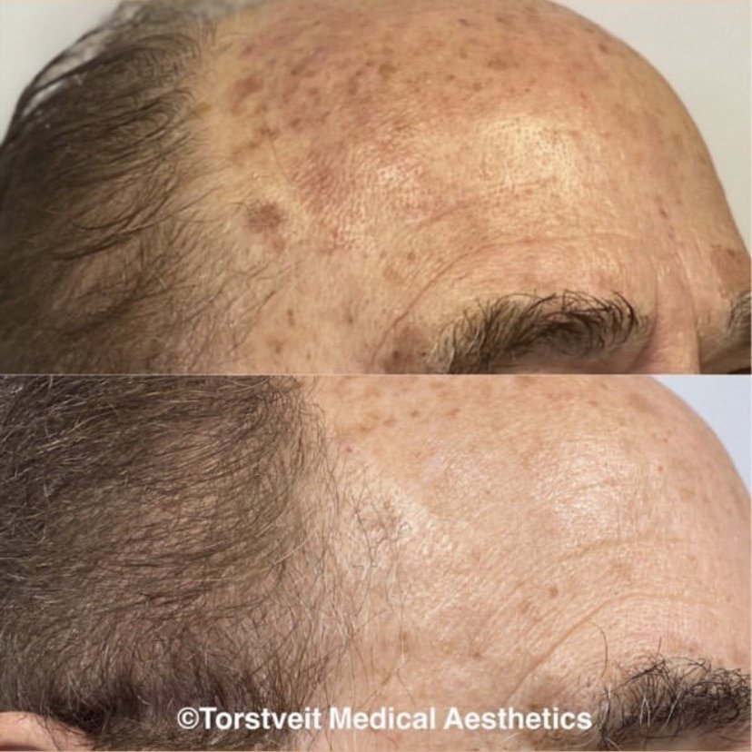 BBL Hero Moxi Head Treatment Before & After Photos | Torstveit Medical Aesthetics in Phoenix, AZ