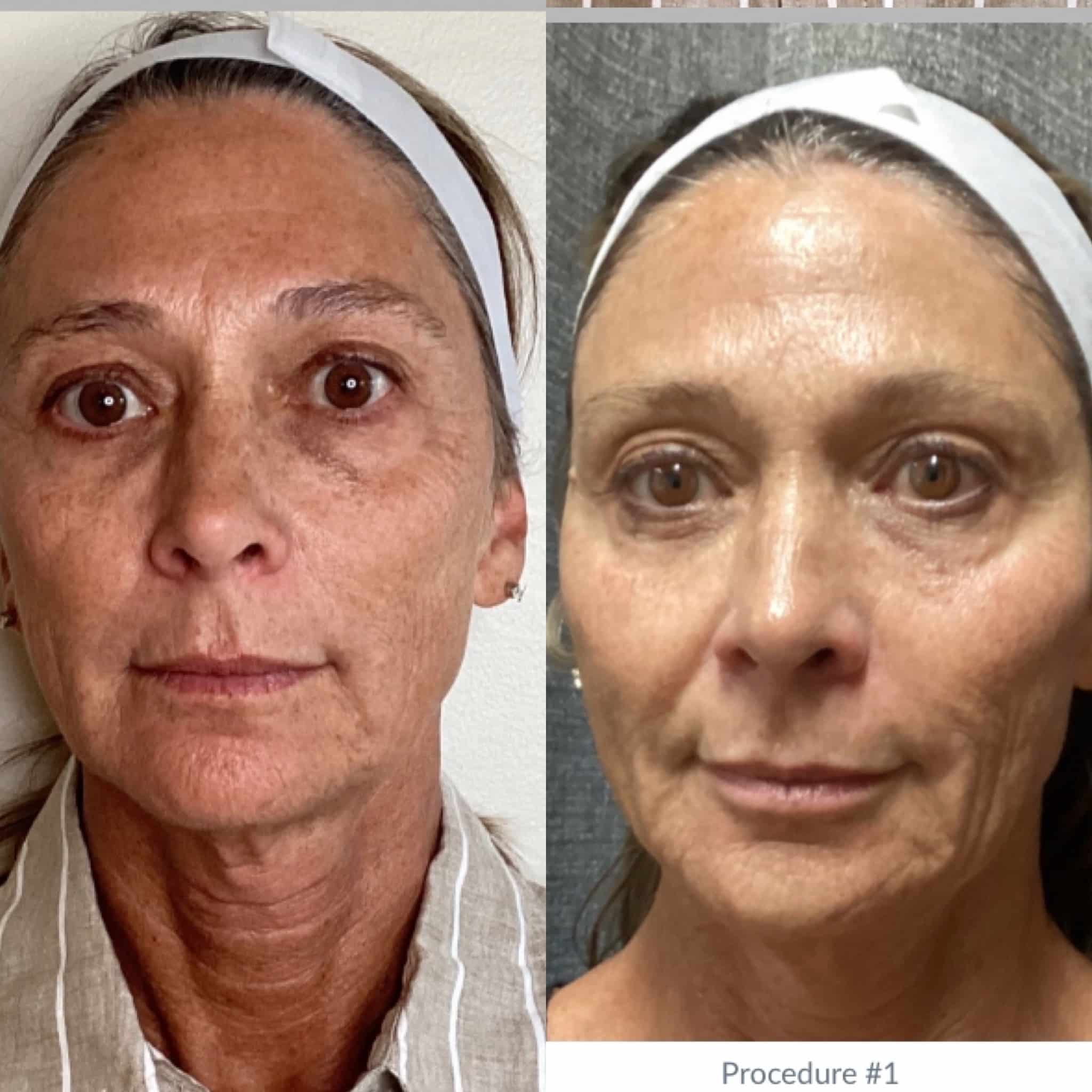 BBL Hero Moxi Treatment Before & After Photos | Torstveit Medical Aesthetics in Phoenix, AZ