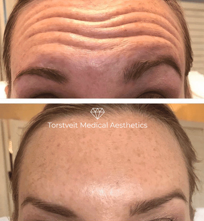 Botox Before & After Female's Forehead | Torstveit Medical Aesthetics in Phoenix, AZ