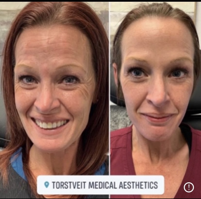 Botox Before & After Treatment | Torstveit Medical Aesthetics in Phoenix, AZ