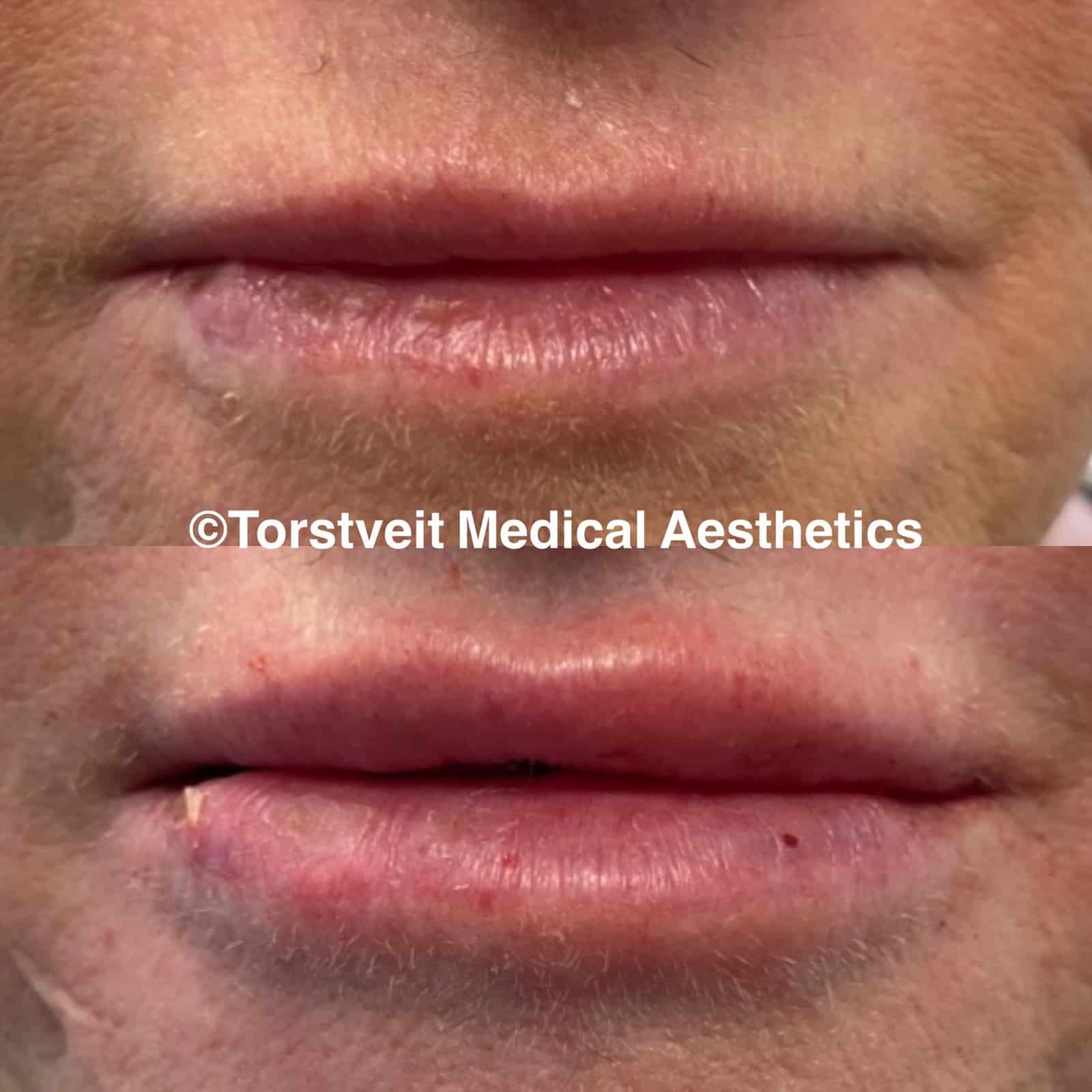 Lip Filler Before and After Treatment Photos | Torstveit Medical Aesthetics in Phoenix, AZ