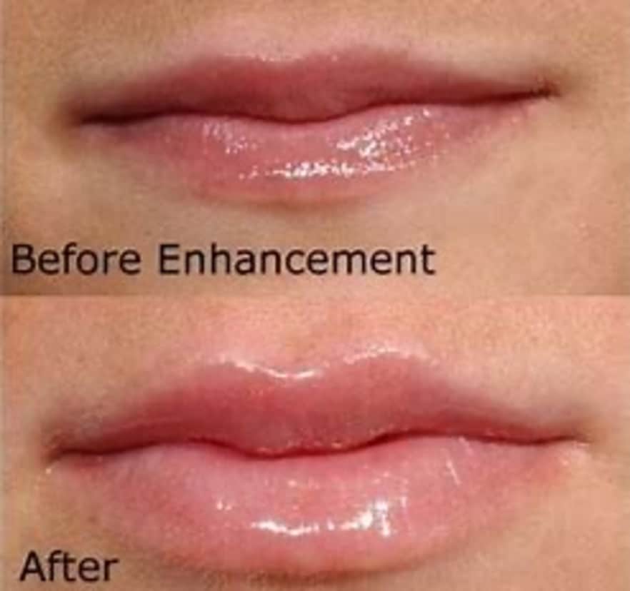 Lip Enhancement Before and After Photos | Torstveit Medical Aesthetics in Phoenix, AZ