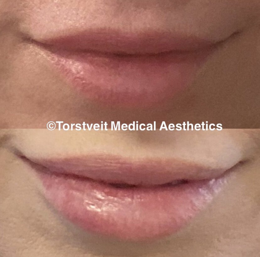 Lip Filler Before and After Treatment Photos | Torstveit Medical Aesthetics in Phoenix, AZ