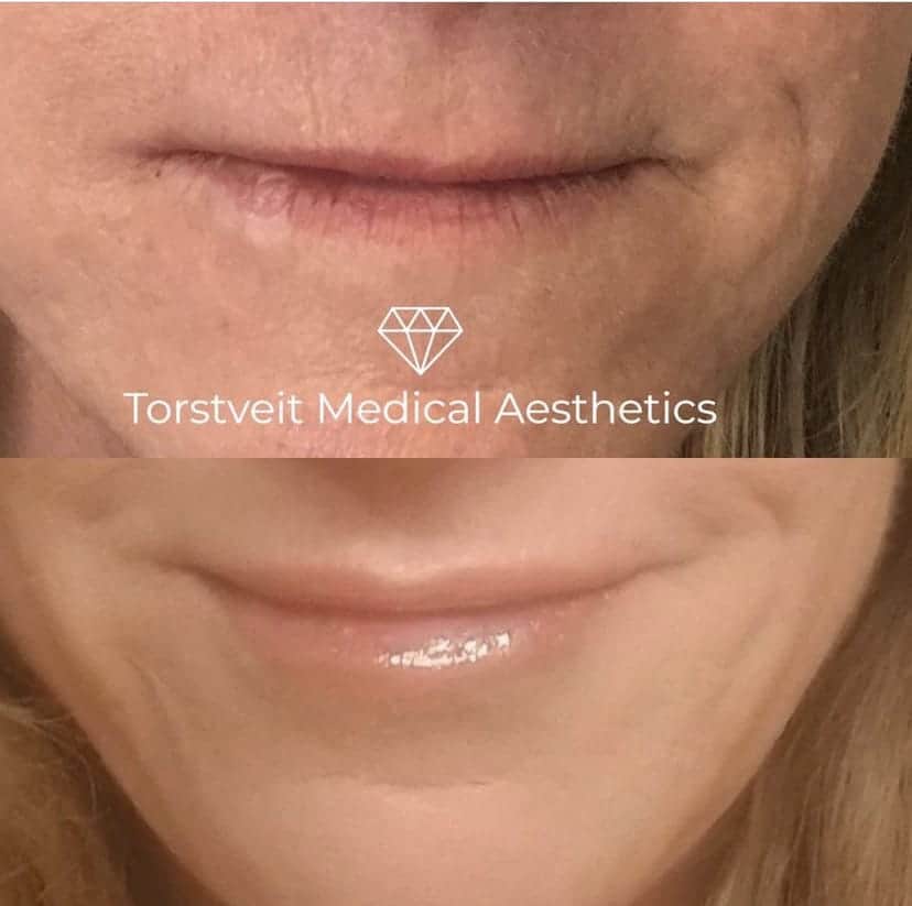 Lip Filler Before and After Treatment Photos | Torstveit Medical Aesthetics in Phoenix, AZ