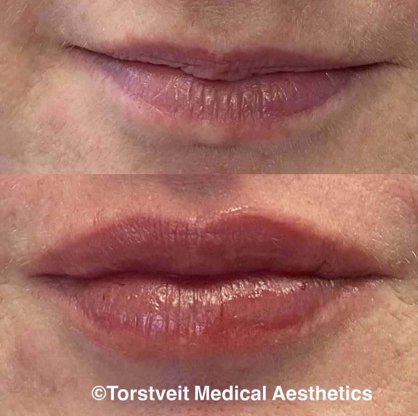 Lip Filler Before and After Treatment Photos | Torstveit Medical Aesthetics in Phoenix, AZ