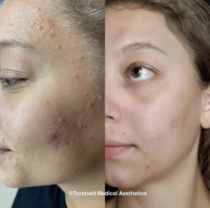 Moxi Laser Treatment Before & After Photos | Torstveit Medical Aesthetics in Phoenix, AZ