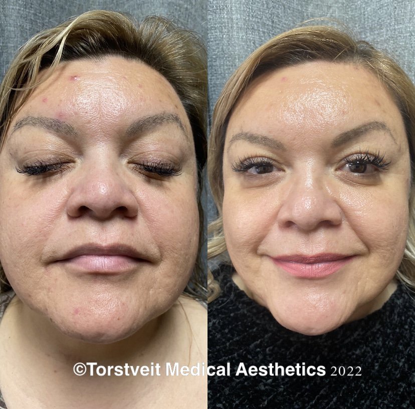 Moxi Laser Treatment Before & After Photos | Torstveit Medical Aesthetics in Phoenix, AZ