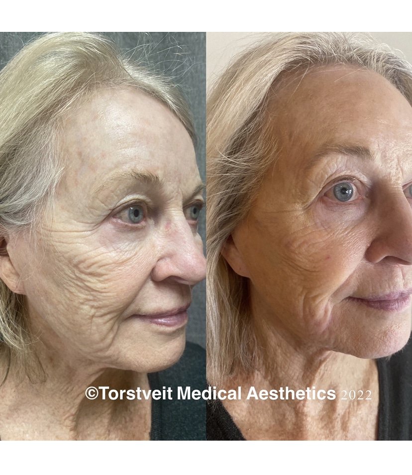 Moxi Laser Treatment Before & After Photos | Torstveit Medical Aesthetics in Phoenix, AZ