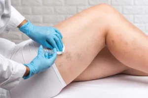 Sclerotherapy in Phoenix, AZ by Torstveit Medical Aesthetics