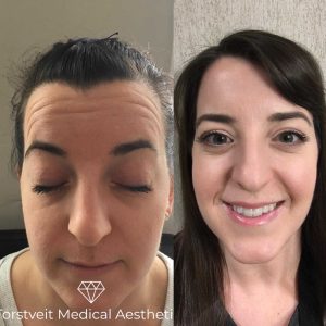 Botox Before & After Treatment | Torstveit Medical Aesthetics in Phoenix, AZ