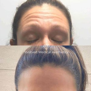 Botox Before & After Female's Forehead | Torstveit Medical Aesthetics in Phoenix, AZ