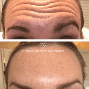 Botox Before & After Female's Forehead | Torstveit Medical Aesthetics in Phoenix, AZ