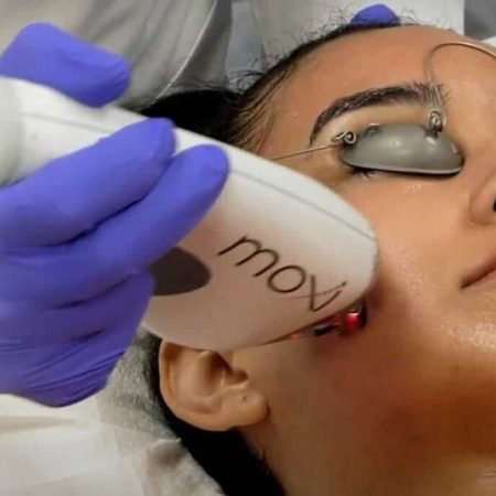 A Young lady getting laser treatment by Moxi Device | Torstveit Medical Aesthetics in Phoenix AZ