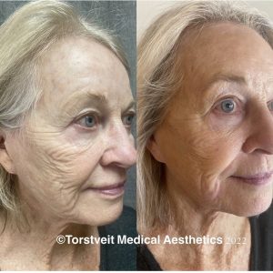 Moxi Laser Treatment Before & After Photos | Torstveit Medical Aesthetics in Phoenix, AZ